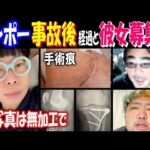 【ニンポー】事故後の経過と彼女募集!?「顔写真は無加工必須で」【よっさん】【ぱるぱる】